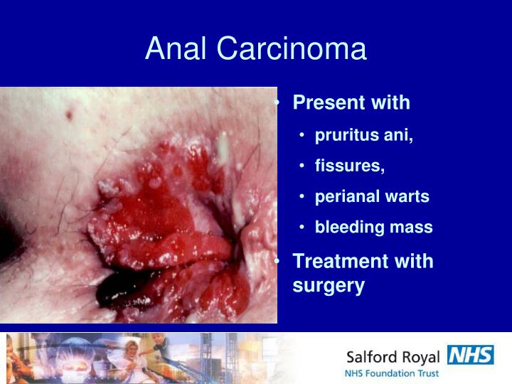 selena naked xxx girls anal rectal carcinoma