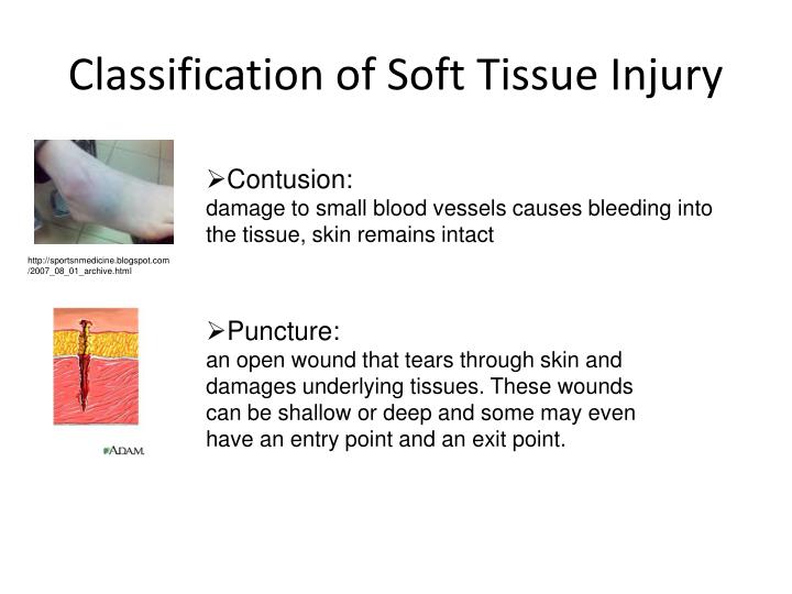 PPT - Soft Tissue Injury PowerPoint Presentation - ID:1634436