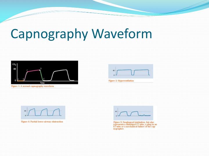 what point(s) on the capnographic waveform represents) a mixture of alveolar gas and dead space gas what point(s) on the capnographic waveform represents) a mixture of alveolar gas and dead space gas