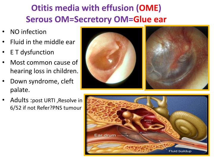 Adult Otitis Media With Effusion 98