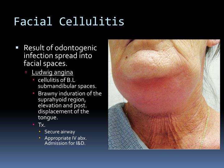 what is facial cellulitis