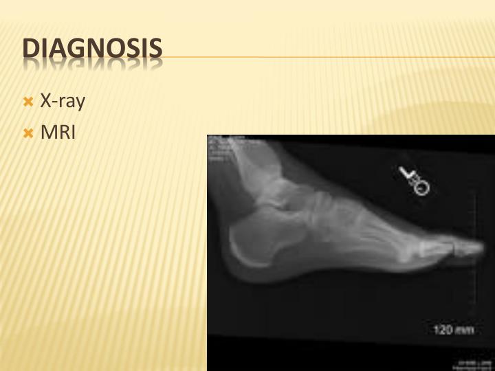 PPT PLANTAR FASCIITIS, CALCANEAL SPuR &amp; TENDO ACHILlITIS