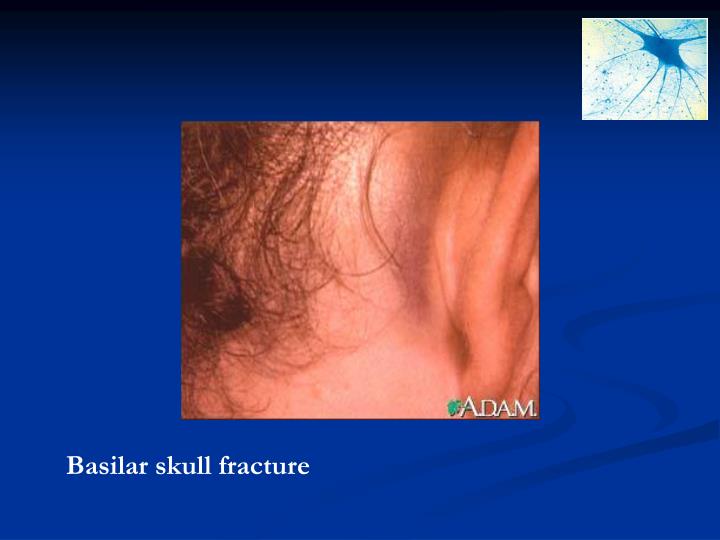basilar fracture symptoms
