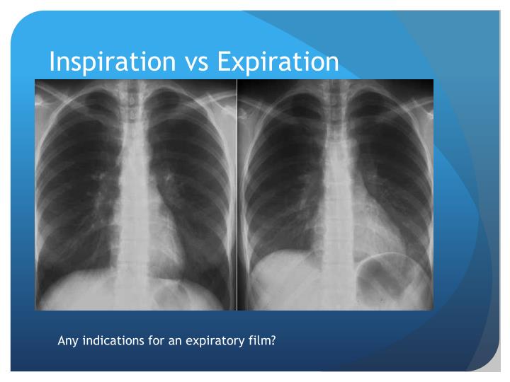direct exposure x-ray film direct exposure x-ray film