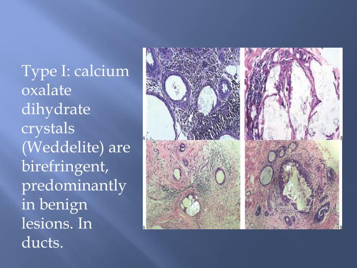 Ppt Microcalcification In Benign Breast Disease Powerpoint Presentation Id