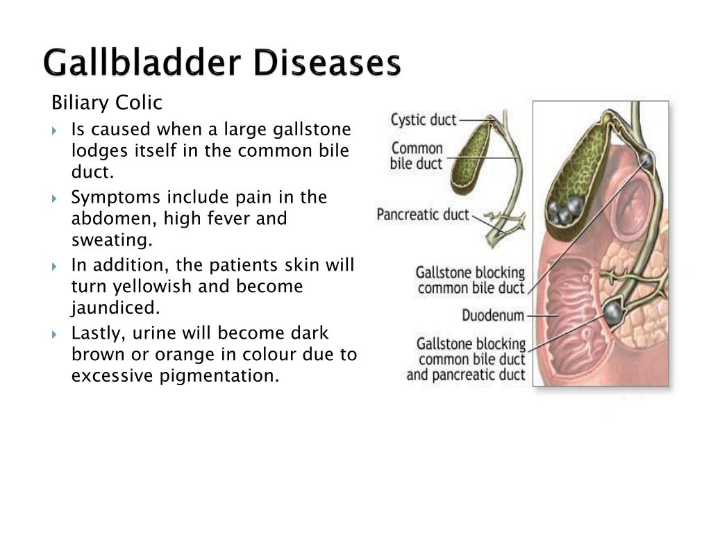 Bladder Diseases Pictures