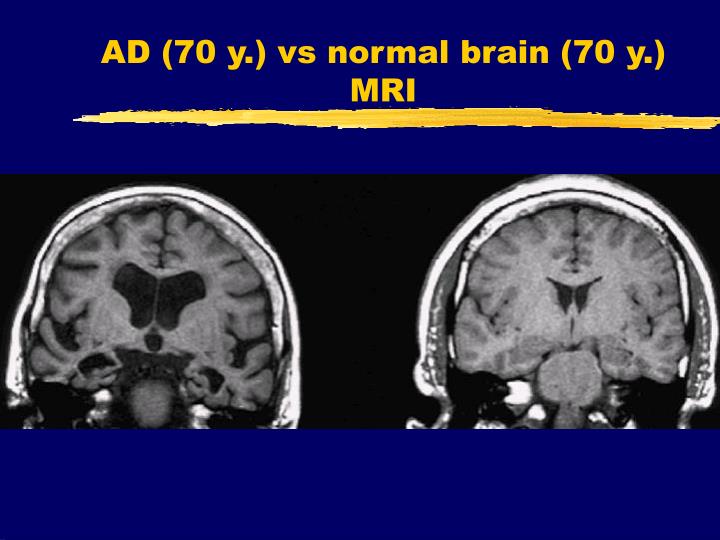 Normal Brain Mri Vs Dementia