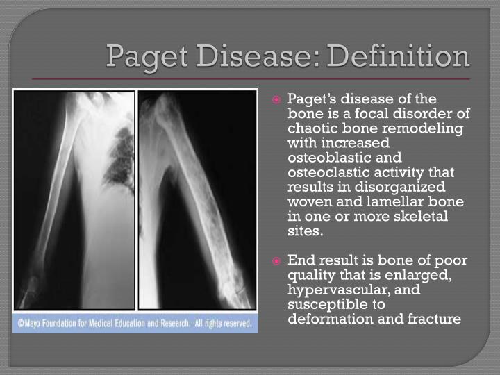 PPT Paget Disease PowerPoint Presentation ID 2153842