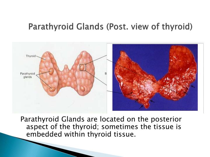 PPT - Hyperparathyroidism PowerPoint Presentation - ID:2174461