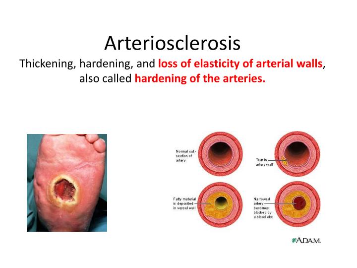 How To Treat Hardening Of The Arteries Naturally How To Treat Hardening Of The Arteries Naturally