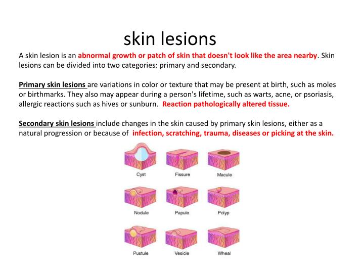 psoriasis a disease affecting the integumentary How does impetigo affect the integumentary system by julia (ringworm, head lice, impetigo, strep, staph, skin cancer) that affect the integumentary (skin) system and methods of prevention staying healthy, 331 sun protection, explain how personal choices affect the function of the digestive system (nutrition, disease prevention, alcohol. psoriasis a disease affecting the integumentary How does impetigo affect the integumentary system by julia (ringworm, head lice, impetigo, strep, staph, skin cancer) that affect the integumentary (skin) system and methods of prevention staying healthy, 331 sun protection, explain how personal choices affect the function of the digestive system (nutrition, disease prevention, alcohol.