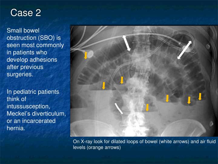hyperactive bowel sounds and abdominal pain hyperactive bowel sounds and abdominal pain