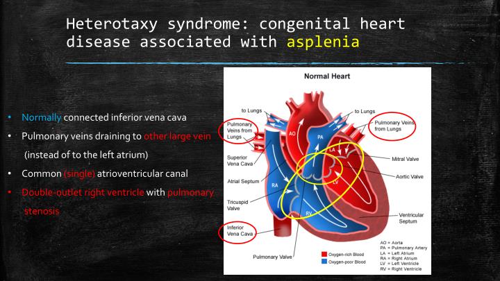 Ppt Congenital Heart Defects And Heterotaxy Syndrome Powerpoint