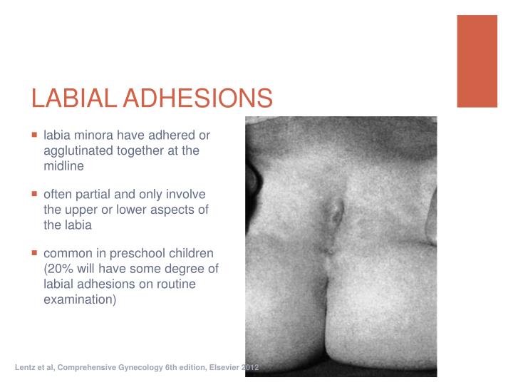 Labial adhesion | BabyCenter