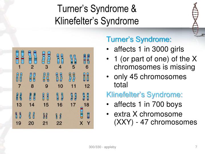 is turner issue dominating or recessive is turner malady major or maybe recessive