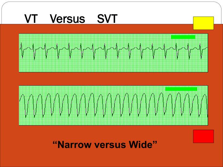 PPT Cardiovascular EKG’s / Cardiac Monitoring PowerPoint