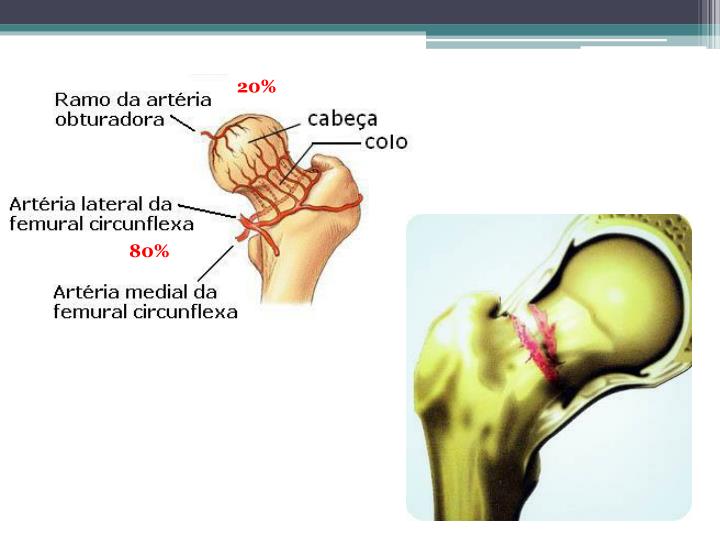 PPT FRATURA PROXIMAL DO FÊMUR PowerPoint Presentation ID 2373612