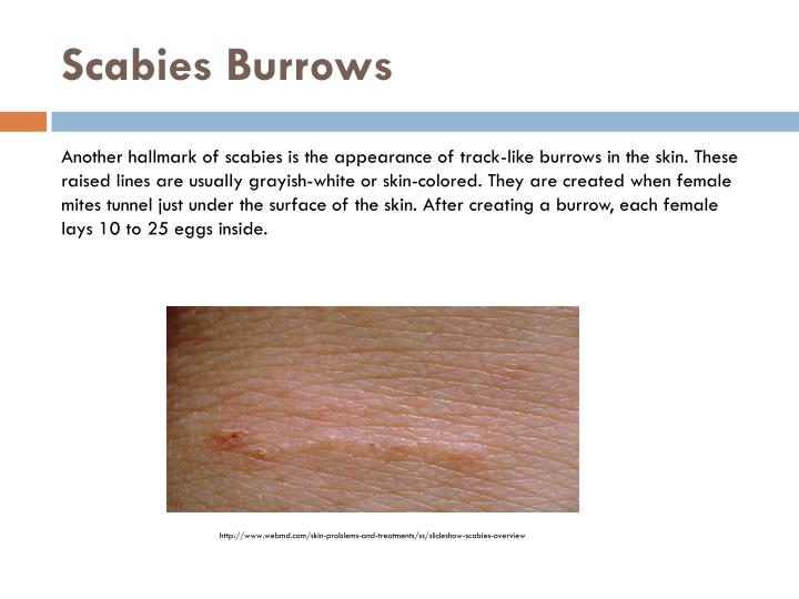 Ppt What Is Scabies Powerpoint Presentation Id 2457230 Free Download