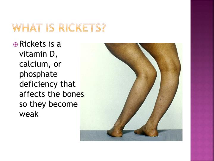 ppt-rickets-powerpoint-presentation-id-2568522