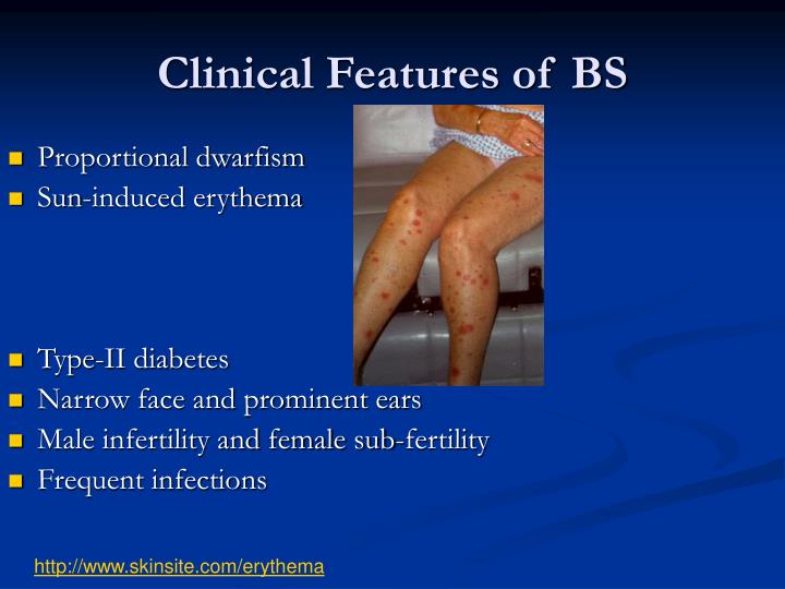 bloom syndrome