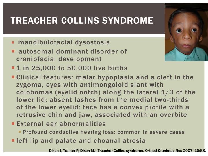 treacher collins syndrome essay A collection of disease information resources and questions answered by our genetic and rare diseases information specialists for treacher collins syndrome. treacher collins syndrome essay A collection of disease information resources and questions answered by our genetic and rare diseases information specialists for treacher collins syndrome.