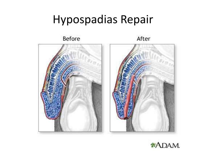 hypospadias repair hydrocele ppt powerpoint cryptorchidism penis stent position tube presentation drainage