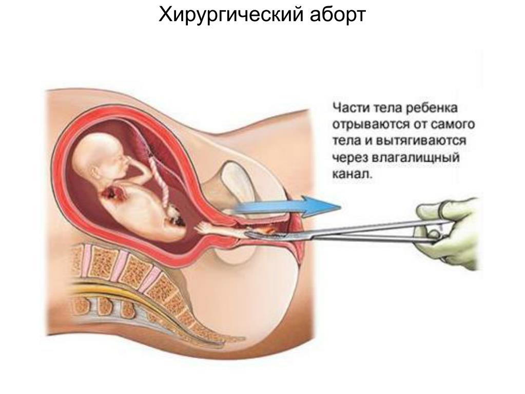 Секс После Вакуумного Аборта