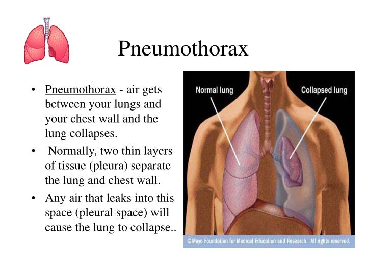 PPT Chest Wounds, Pneumothorax, Tension Pneumothorax and