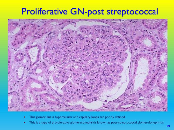 PPT Acute Glomerulonephritis PowerPoint Presentation ID3066382