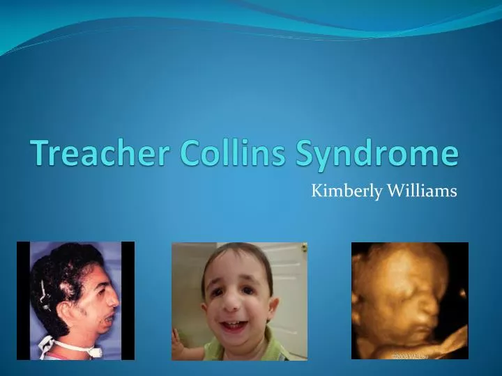 essay on treacher collins syndrome essay on treacher collins syndrome