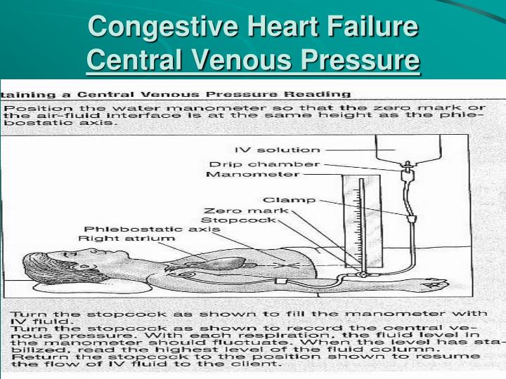 congestive heart failure case study congestive heart failure case study