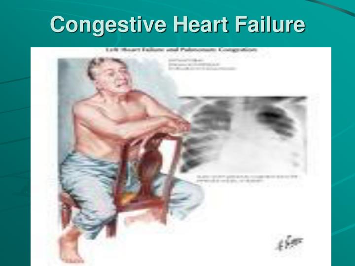 Signs congestive heart failure women
