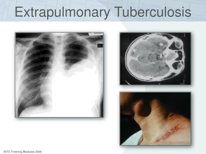 thesis on extrapulmonary tuberculosis thesis on extrapulmonary tuberculosis