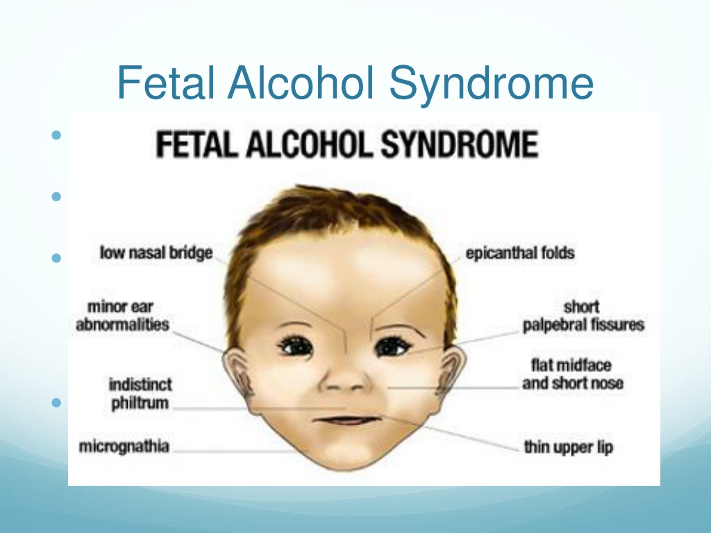 Fetal Alcohol Syndrome Images Of Kids