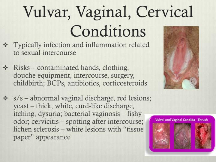 Ppt Benign Diseases Of The Vulva Vagina And Cervix Sexiz Pix 4790
