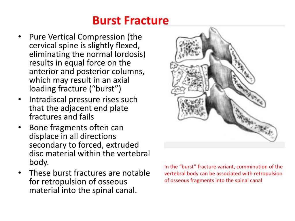 PPT - Cervical Spine Injuries in the Athlete PowerPoint Presentation