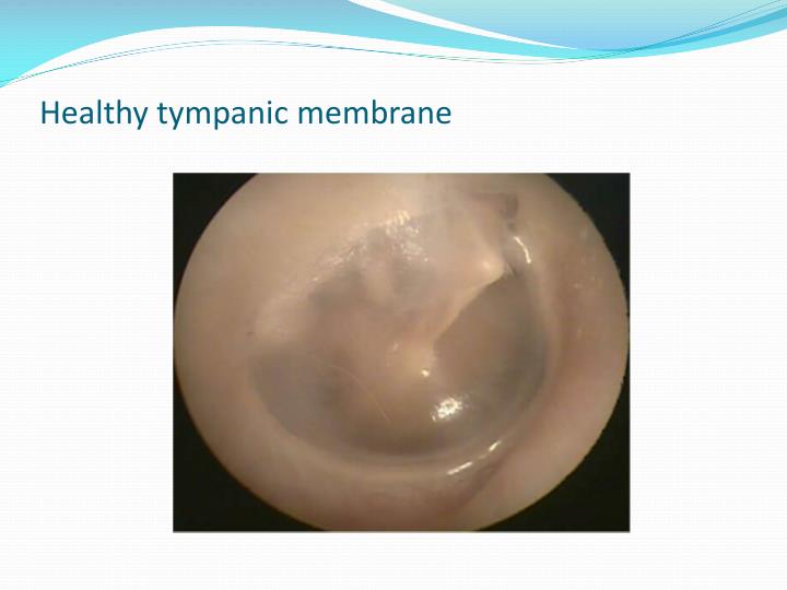 PPT Otitis media PowerPoint Presentation ID1571016