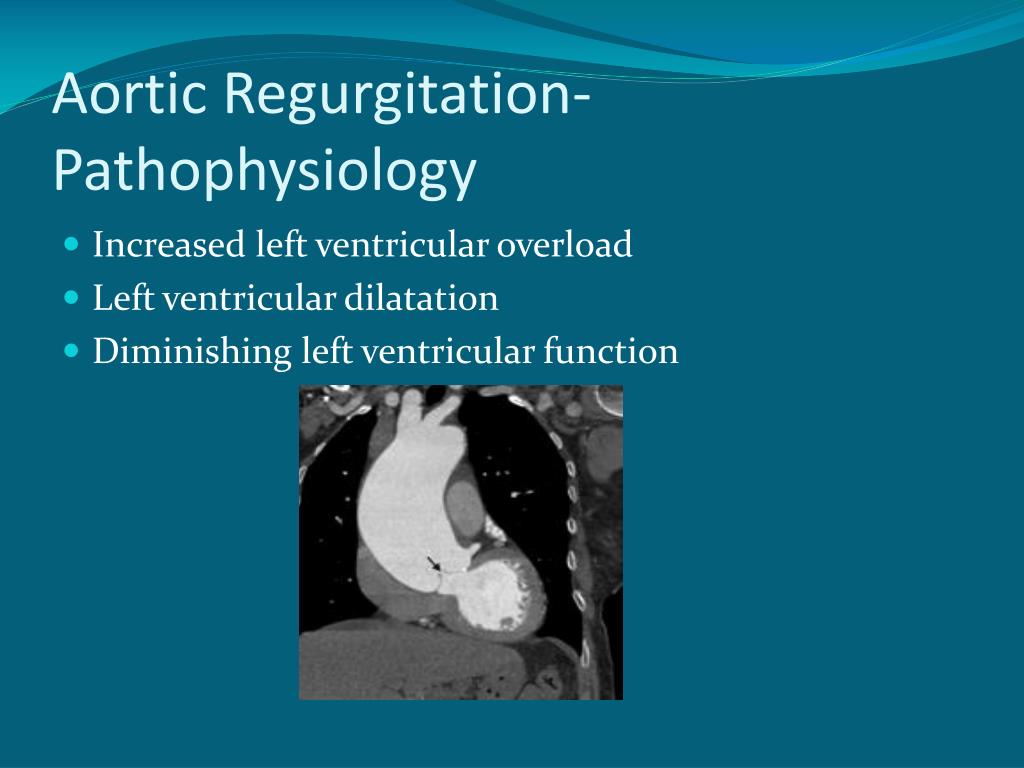 Ppt Surgical Management Of Valvular Heart Disease Powerpoint