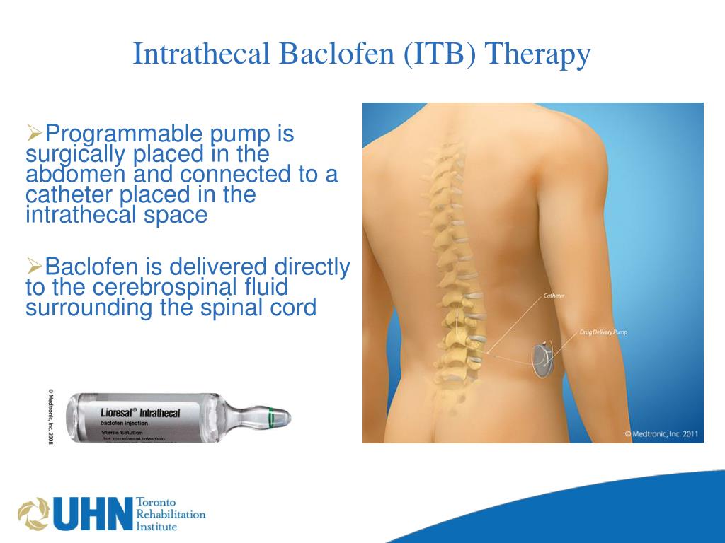 PPT Spasticity And The Use Of The Baclofen Pump For The SCI Patient ppt-spasticity-and-the-use-of-the-baclofen-pump-for-the-sci-patient