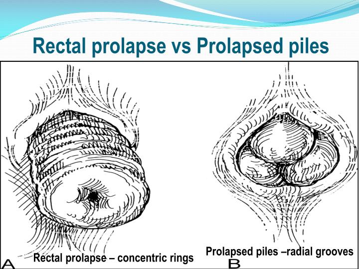 PPT Rectal Prolapse Its Laparoscopic Management A Video 