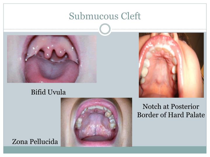 PPT Cleft Lip Palate PowerPoint Presentation ID 1580216 PPT Cleft Lip Palate PowerPoint Presentation ID 1580216
