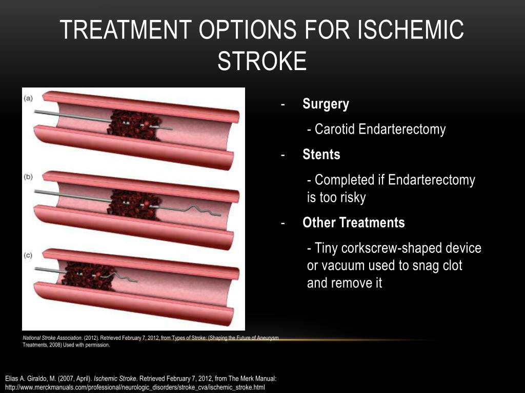 ischemic stroke case study ppt