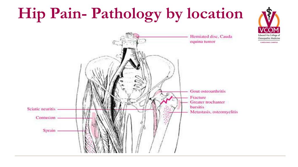 Hip Pain Diagram