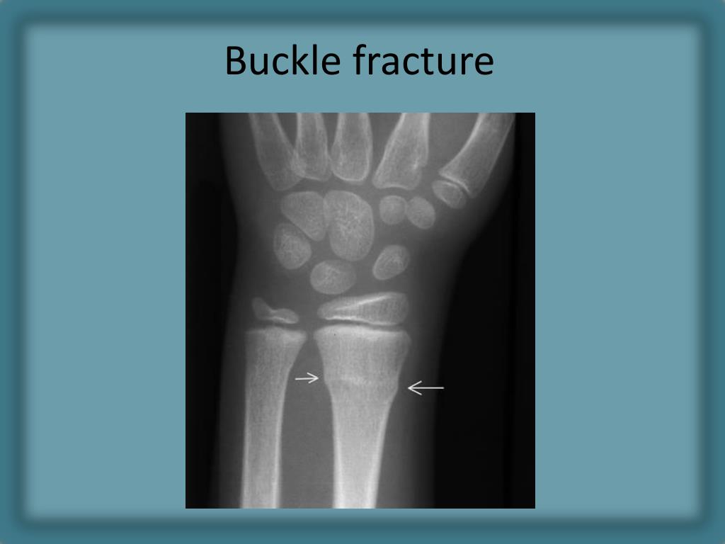 buckle fracture buckle fracture