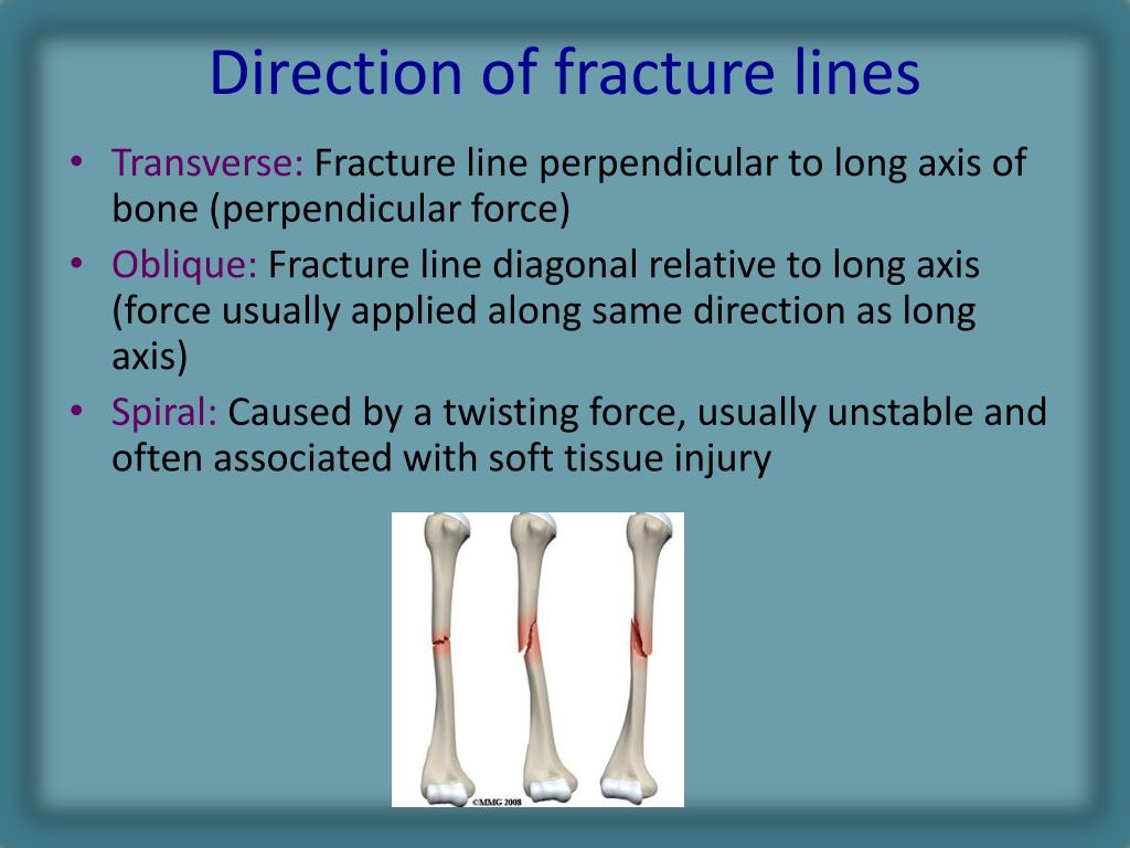 Ppt Radiology Of Fracture Principles Powerpoint Presentation Free