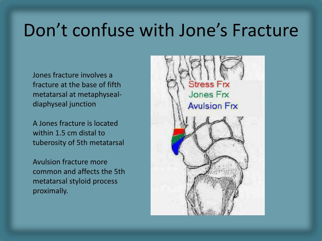 Ppt Radiology Of Fracture Principles Powerpoint Presentation Free