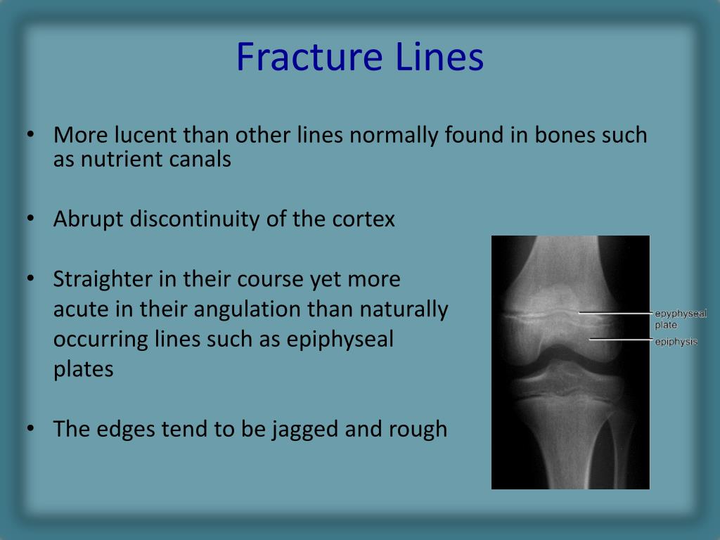 Ppt Radiology Of Fracture Principles Powerpoint Presentation Free