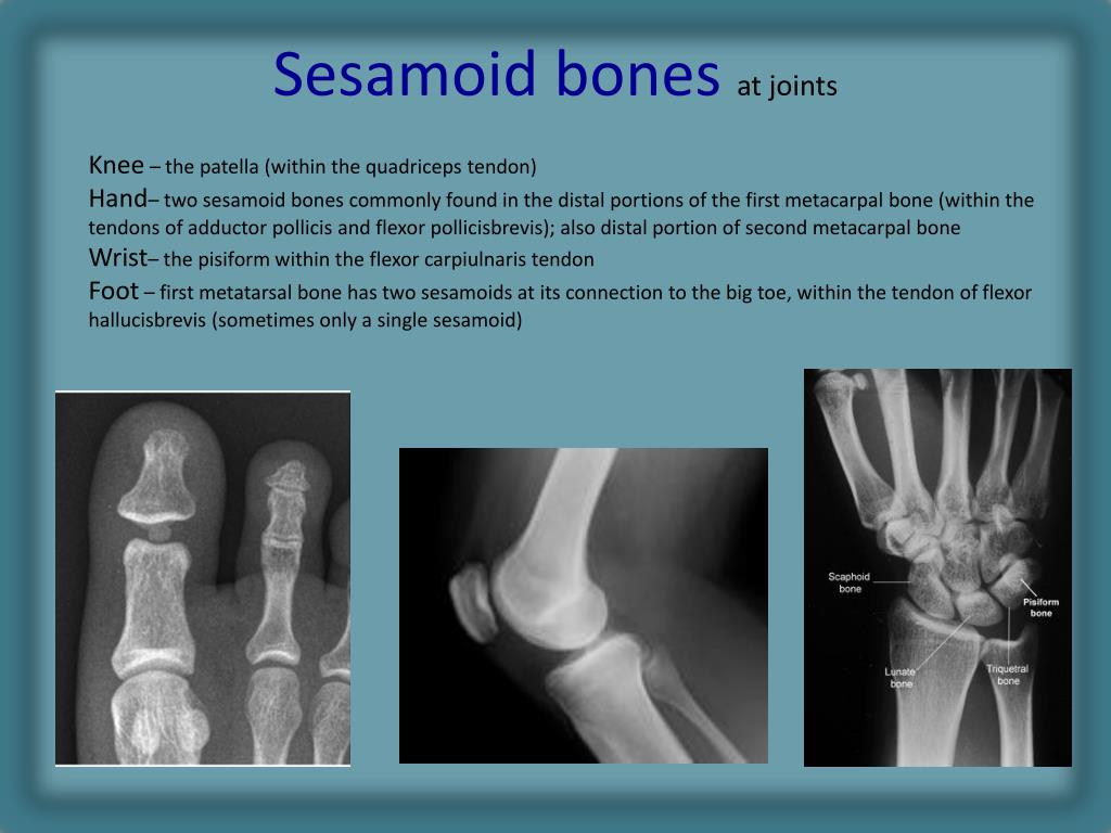 hand sesamoid bone
