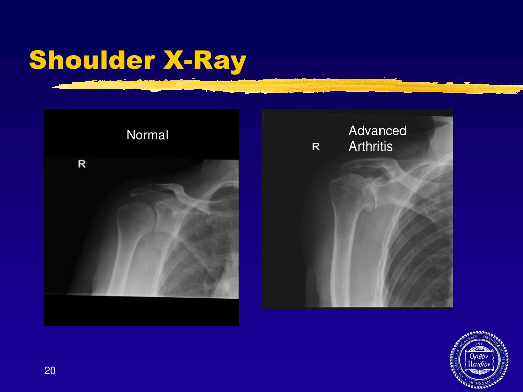 PPT Arthritis Seminar Solutions for Knee, Shoulder and Hip PowerPoint Presentation ID1590713