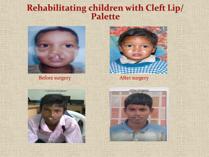 cleft lip palate Overview clefts of the lip and palate occur in roughly 1 in 1000 births, making clefts one of the most common congenital anomalies that we see in our center. cleft lip palate Overview clefts of the lip and palate occur in roughly 1 in 1000 births, making clefts one of the most common congenital anomalies that we see in our center.